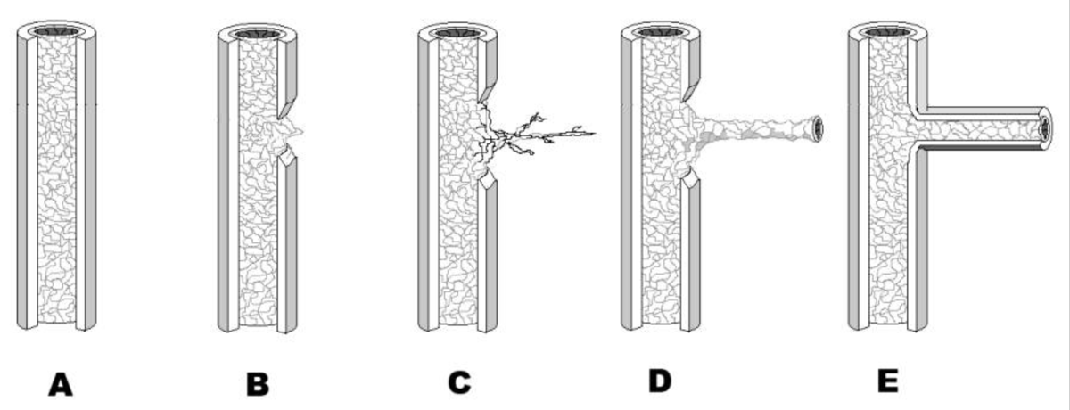 Diagram of the stages of sprouting angiogenesis